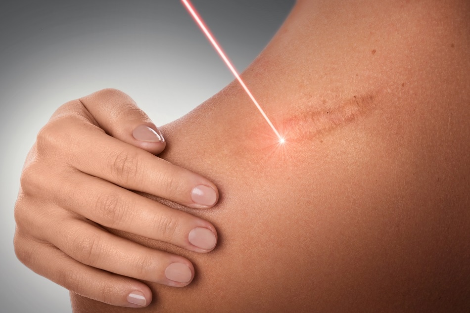Laser scar removal