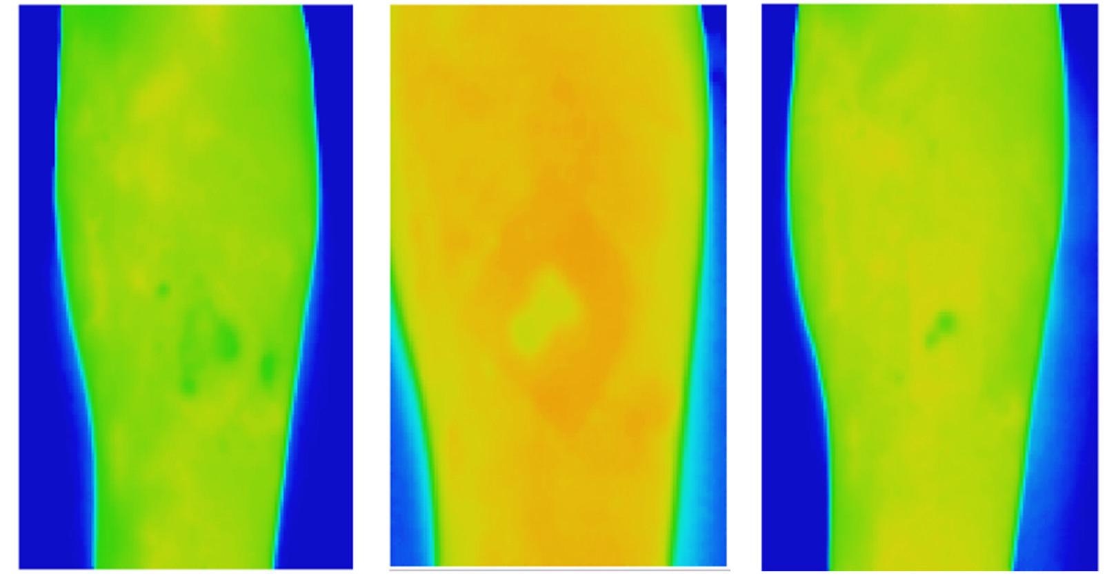 New Thermal Imaging Technique can Improve Chronic Wound Care