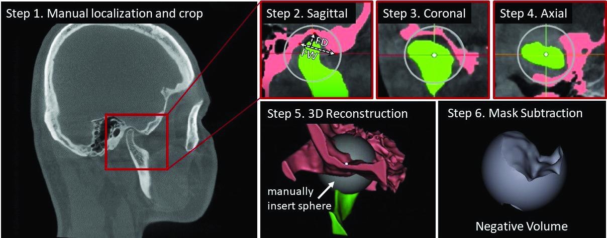 Steps in the manual annotation of the temporomandibular joint using the negative volume approach