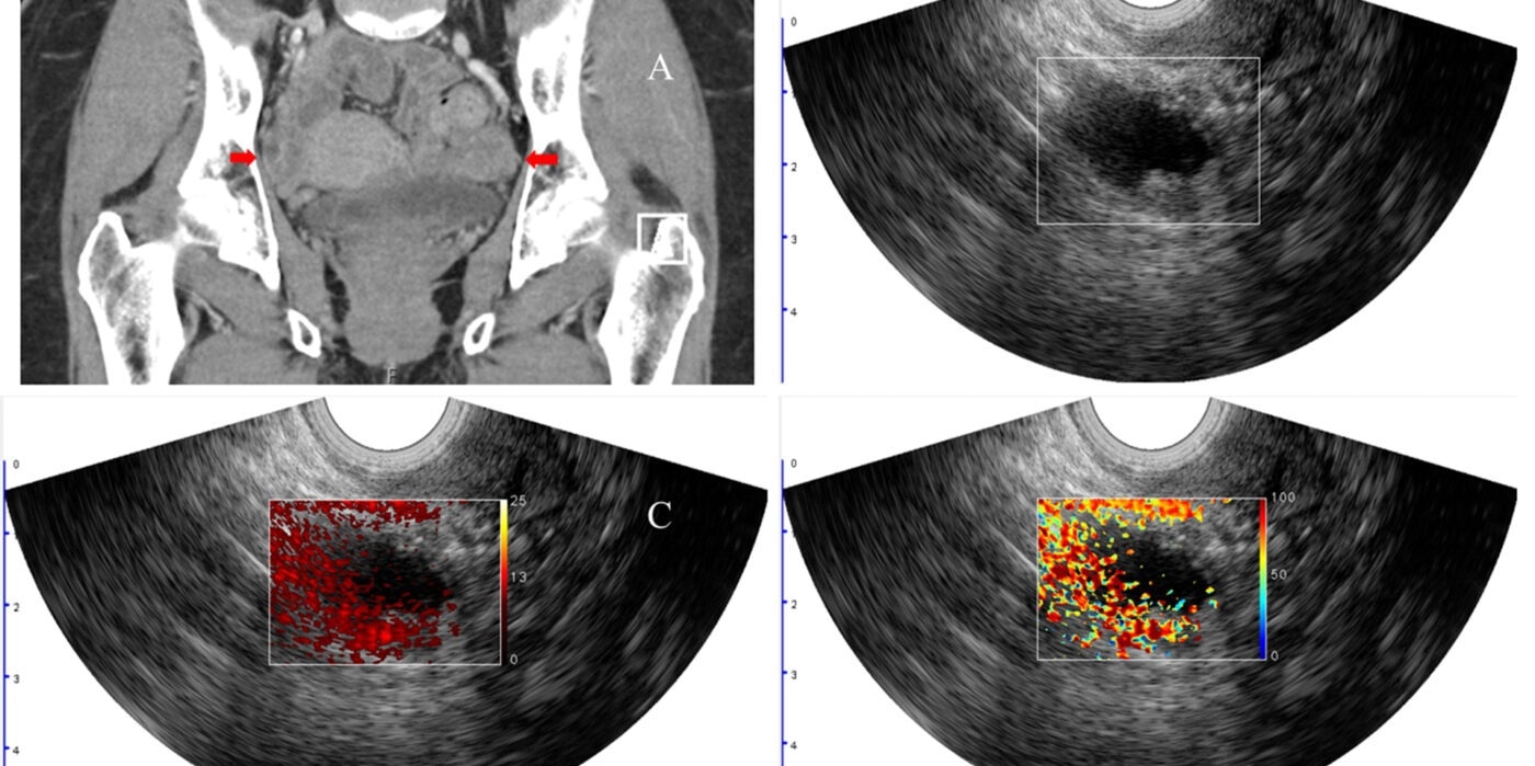 Photoacoustic Imaging Improves Malignant Ovarian Lesion Diagnosis