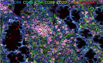 Novel Imaging Technology Used to Map Cells of Inflammatory Bowel Disease