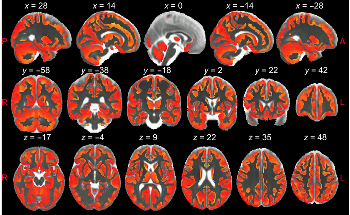 Brain Inflammation Identified in MRI for the Very First Time, a New Study Shows