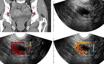 Photoacoustic Imaging Improves Malignant Ovarian Lesion Diagnosis